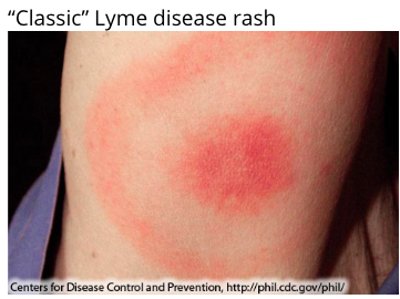Lyme disease target rash