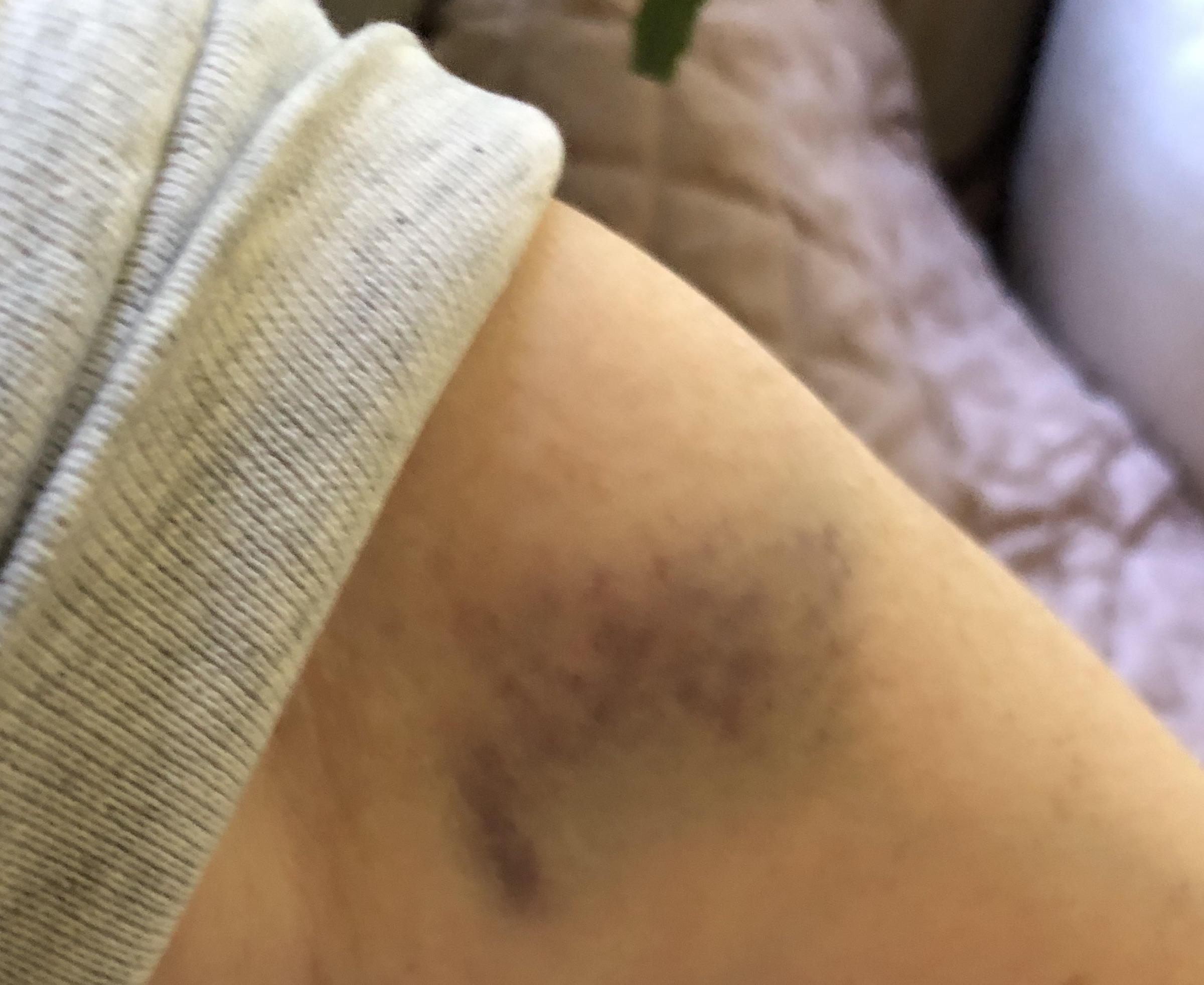 arm bruise