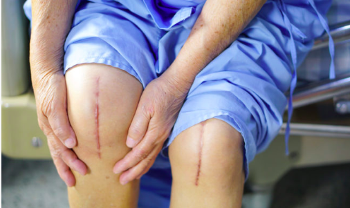 Caring for a total knee replacement patient